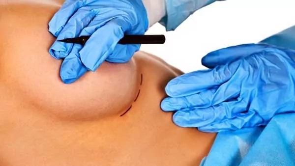 Docteur Vladimir MITZ chirurgien Paris 6 75006 chirurgie esthetique chirurgie du corps chirurgie des seins methode d augmentation mammaire avec implants
