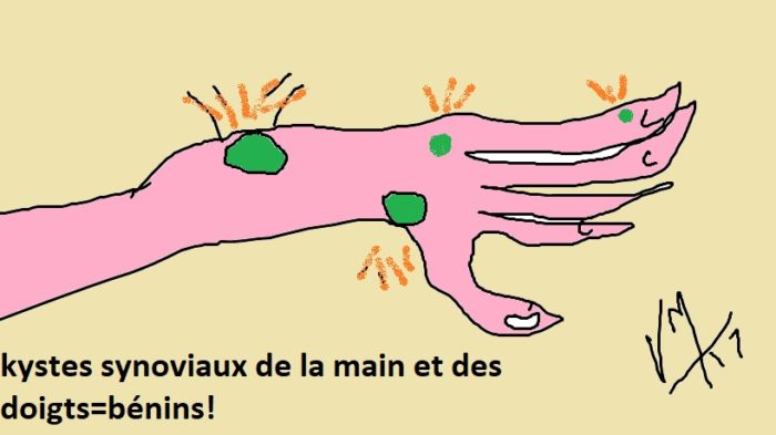 Docteur Vladimir MITZ chirurgien Paris 6 75006 chirurgie reparatrice chirurgie des mains Traitement des kystes 200