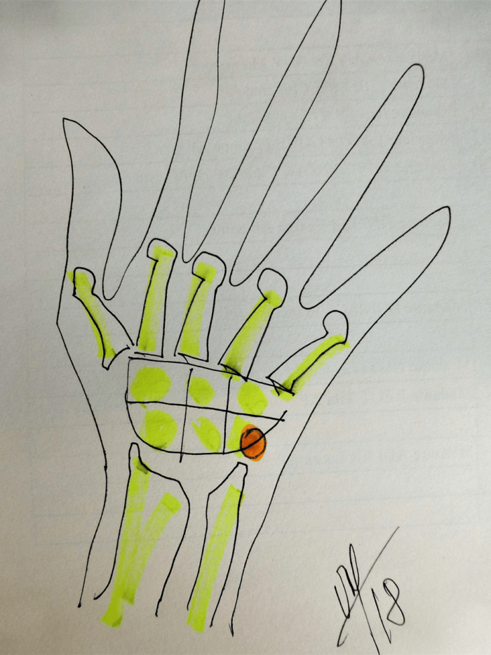 chirurgie de la main chirurgie reparatrice pisiforme