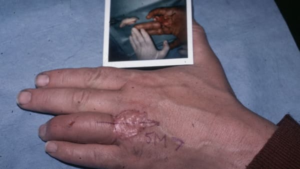 amputation doigt amputation digitale doigt coupe chirurgie reparatrice docteur vladimir mitz chirurgien esthetique paris 6