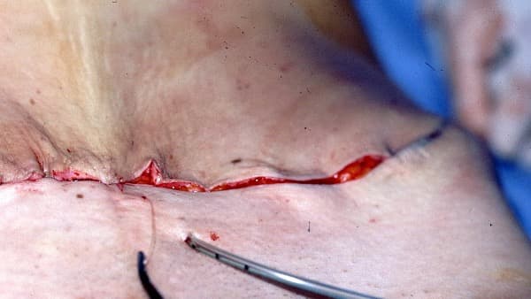 cicatrice plastie abdominale abdominoplastie chirurgien esthetique paris docteur mitz