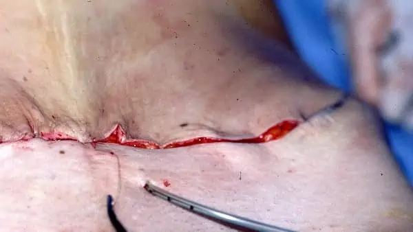 cicatrice plastie abdominale abdominoplastie chirurgien esthetique paris docteur mitz