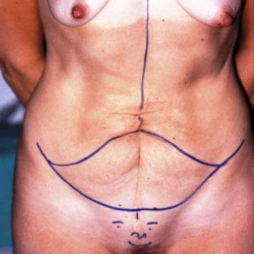 dessin excision cutanee abdominoplastie plastie abdominale paris docteur vladimir mitz chirurgien esthetique paris