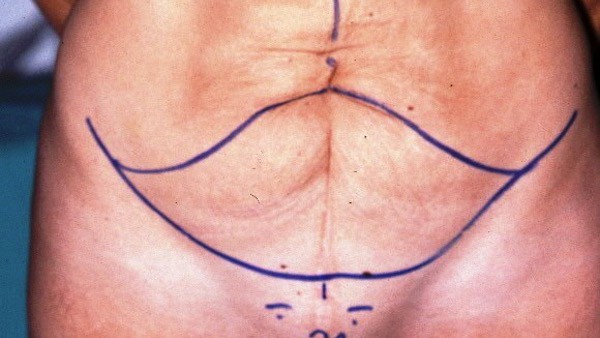 dessin excision cutanee abdominoplastie plastie abdominale paris dr vladimir mitz chirurgien esthetique paris