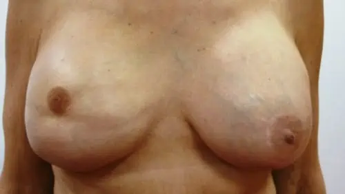 reconstruction mammaire lipofilling mammaire docteur mitz vladimir chirurgien esthetique paris