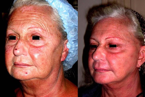 dr mitz vladimir evolution lifting visage 2026